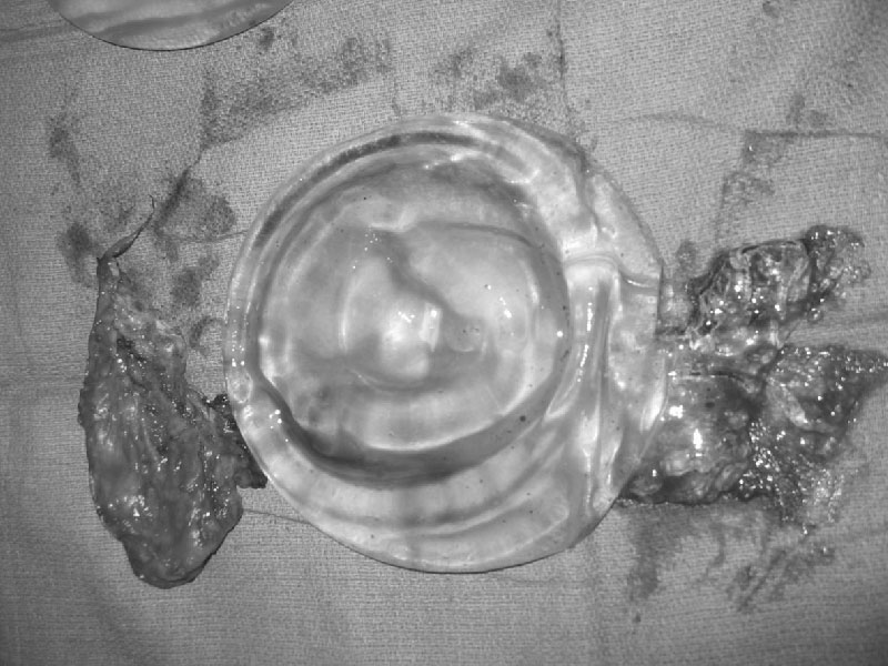 破裂的果凍矽膠假奶與莢膜